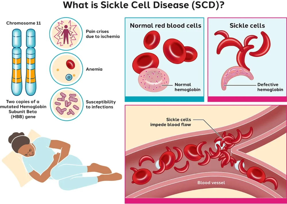 Sickle-Cell-Disease Sickle Cell Disease